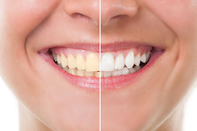 Teeth Whitening - Frank Chang DMD, Irvine Dentist